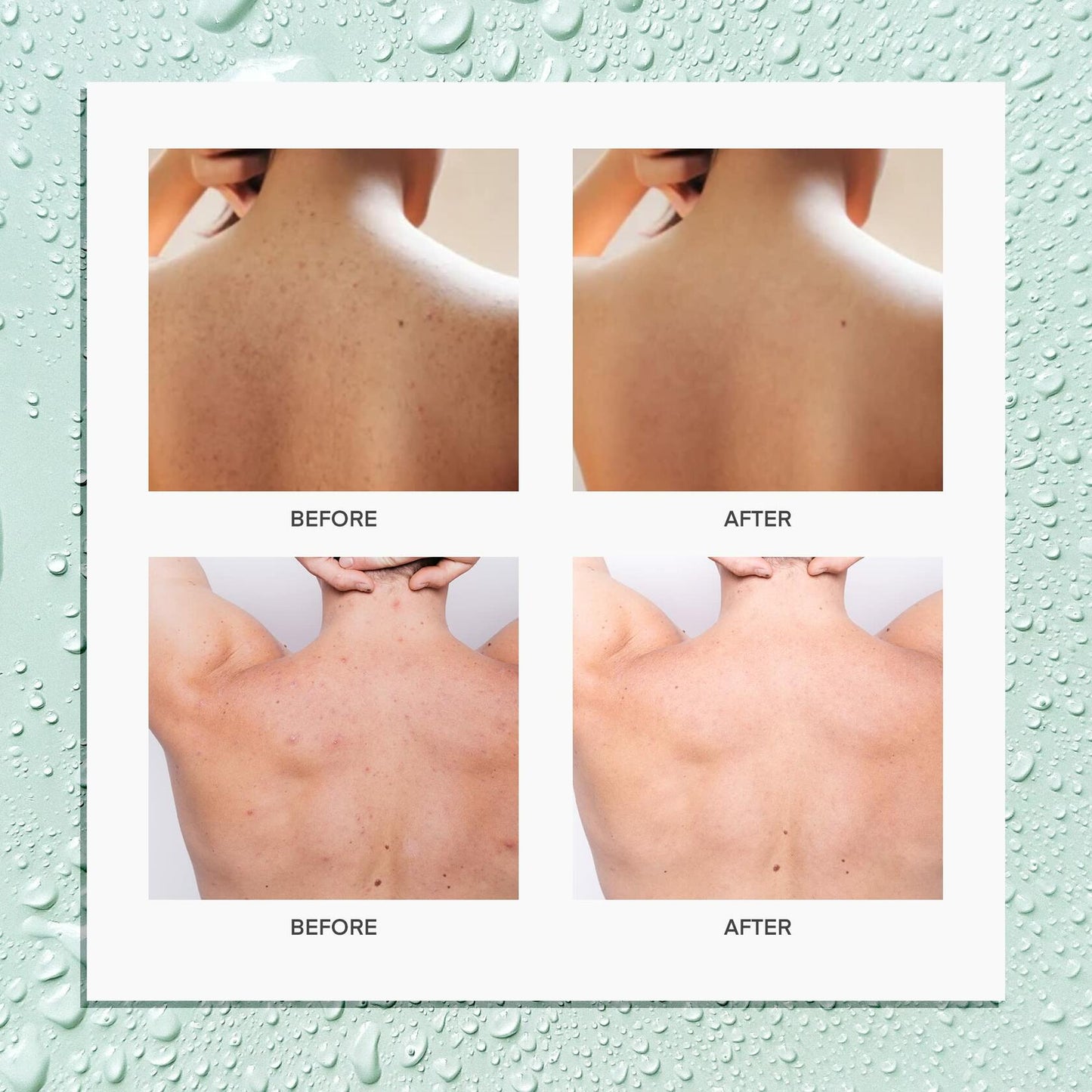 BellamiLuxx Body and Back Acne Treatment Spray: 2% Salicylic Acid & Tea Tree Oil Bacne Spray for Clear, Soothe & Moisturize - Effective for Men, Women, Teens with Back, Shoulder, Arm, and Chest Acne